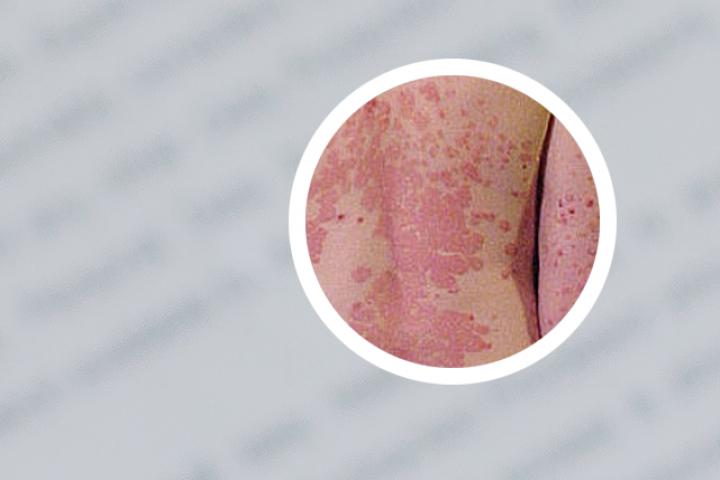 银屑病和丘疹性荨麻疹的区别