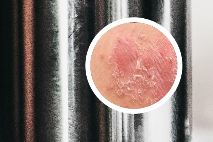 指甲型银屑病是真菌吗