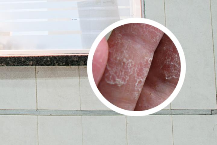 联苯苄唑乳膏可以治疗股癣和脚癣