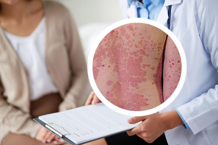 湿疹可以变成银屑病吗