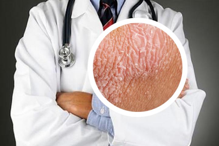 银屑病皮肤平时需要怎么护理