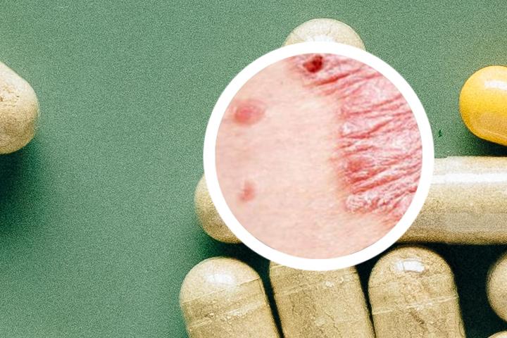 指甲银屑病是什么病