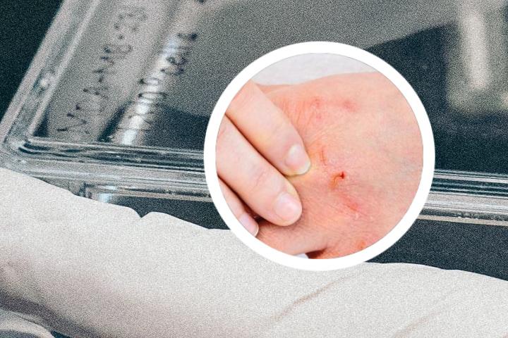 为什么得了银屑病手脚角化指甲变黄