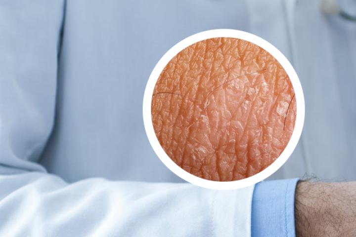 广泛皮肤病包括银屑病吗