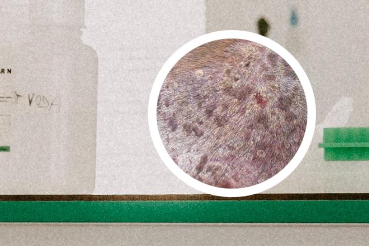 毛发红糖疹与银屑病的区别图片