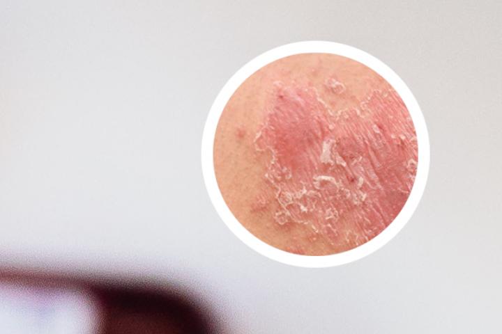 银屑病和湿疹有什么区别图片
