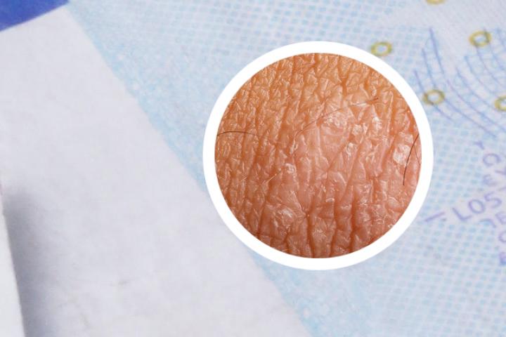 红皮型银屑病能转为皮肤癌吗
