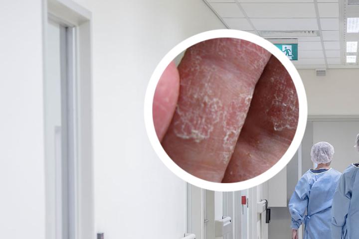 银屑病和痒疹有什么区别