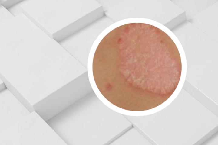 安敏滋保湿膏治疗过敏性皮肤病要多久才会有效果