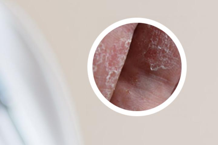 银屑病指甲油滴状是什么样